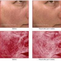 Facial Redness – What Causes it and How Do We Treat it?