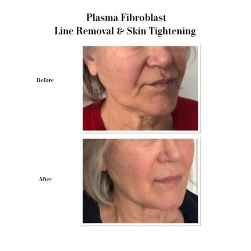 Current Offer – Plasma Fibroblast Mouth Rejuvenation Package